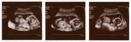 Ultrasound